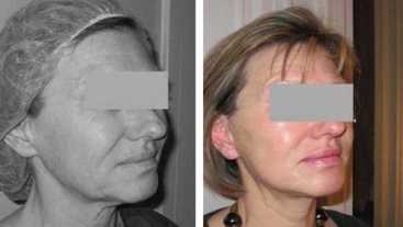 Avant-Après : Lifting cervico-facial