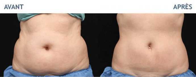 Before & After pictures of Cryolipolyse with Coolsculpting treatment