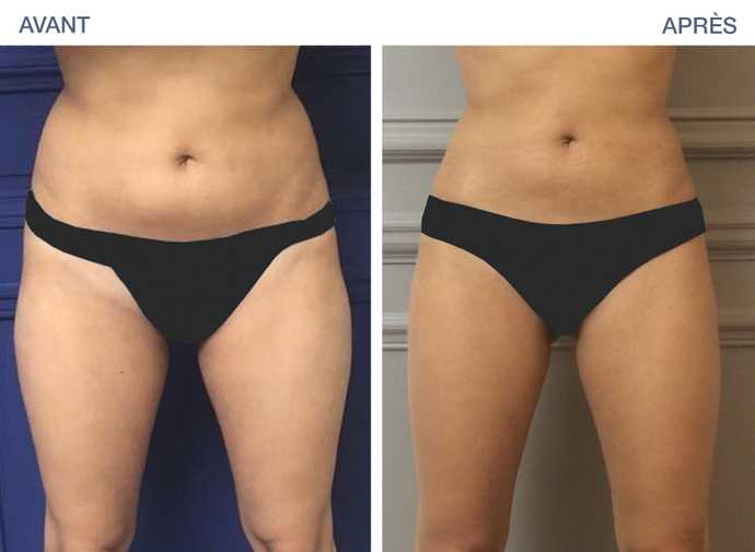 Before - After: Thinning of the hips by cryolipolysis with Coolsculpting