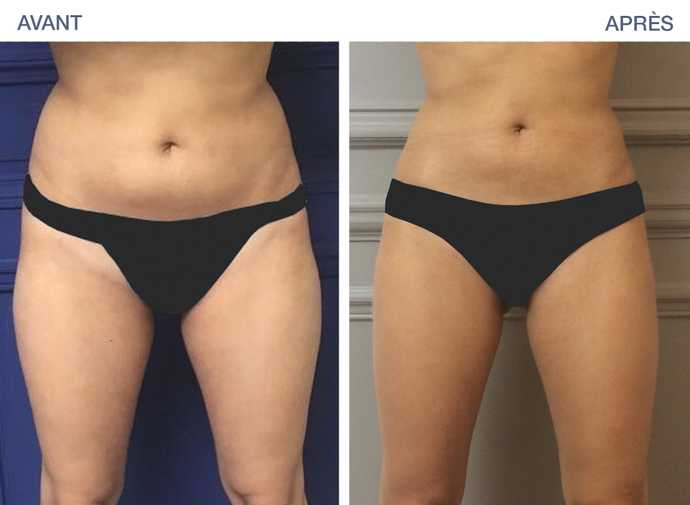 Avant - Après : Amincissement des hanches par cryolipolyse avec Coolsculpting