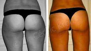 Before & After: Liposuction surgery procedures