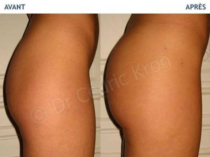 Before - After buttock plastic surgery