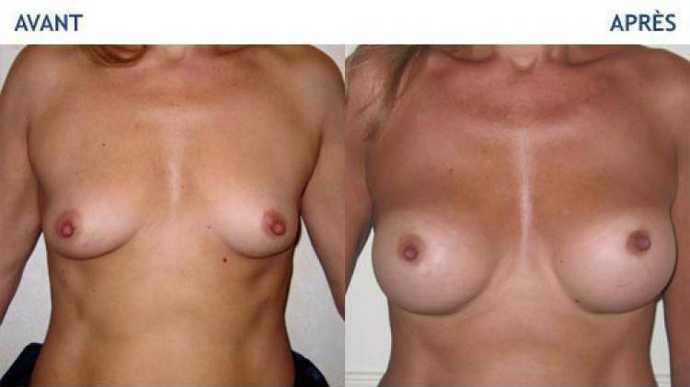 Before - After breast augmentation using implants