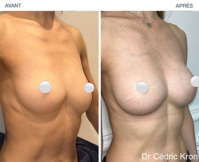 Avant - Après : Augmentation mammaire par prothèse