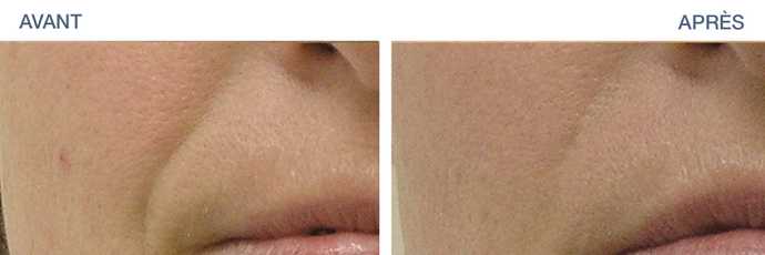 Before - After: HydraFacial result on the nasolabial folds