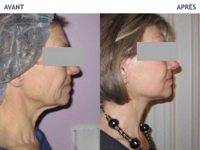 Avant - Après Lifting cervico-facial