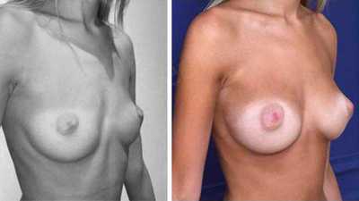 Before & After photos of plastic and cosmetic surgery in Paris