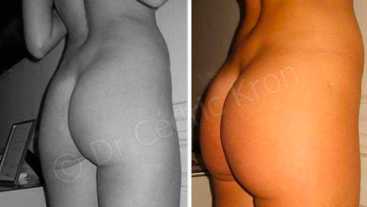 Before & After: Buttock enhancement