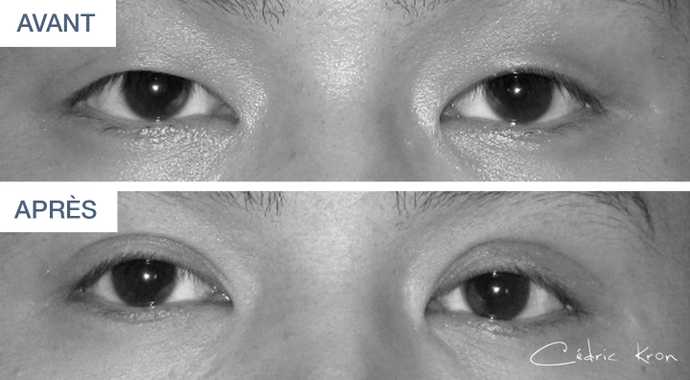 Avant - Après d'une blépharoplastie asiatique réalisée sur un homme (vue de face)