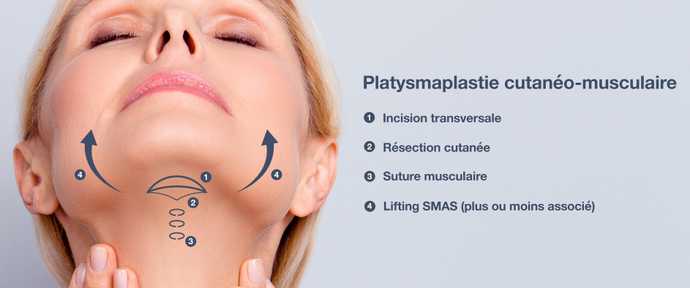 Schéma d'une platysmaplastie cutanéo-musculaire dans le cadre d'un lifting du visage