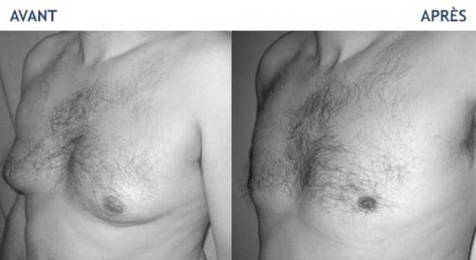 Before and after pictures of a treatment of Men's Gynecomastia and adipomastia