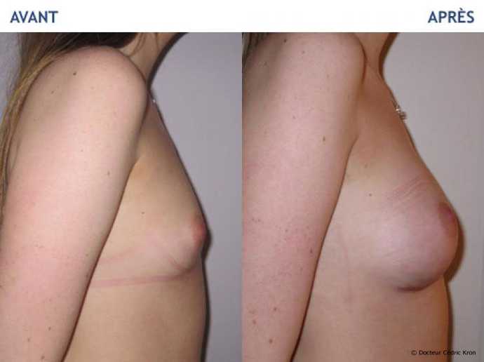 Before - After breast augmentation using implants