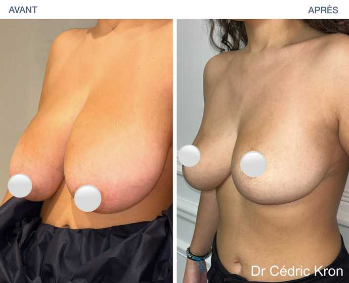 Avant-après : réduction mammaire  sur une femme de 30 ans
