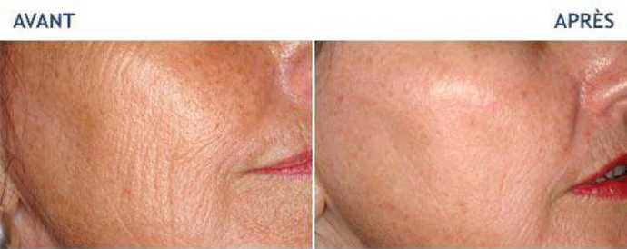 Before and after photos of a laser treatment of deep winkles
