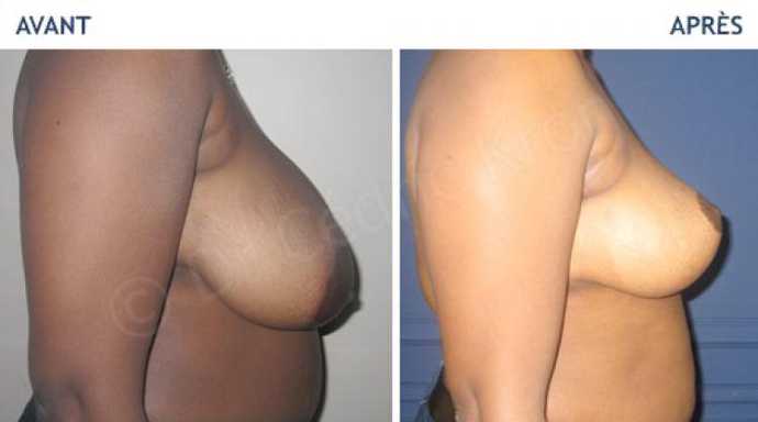 Before - After an aesthetic breast reduction surgery