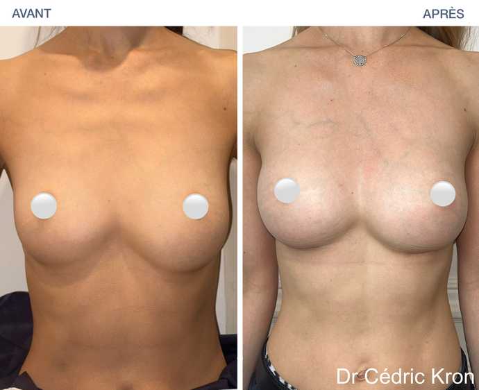 Avant - Après : Augmentation mammaire par prothèse