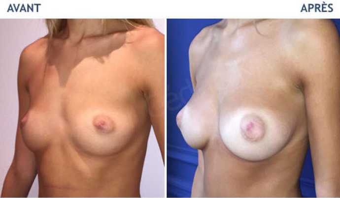 Avant - Après d'une augmentation mammaire par prothèses