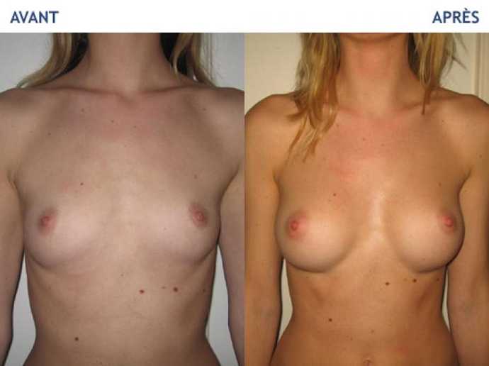 Avant - Après d'une chirurgie esthétiques des seins avec prothéses mammaires