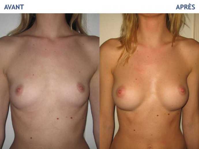 Before - After breast augmentation using implants