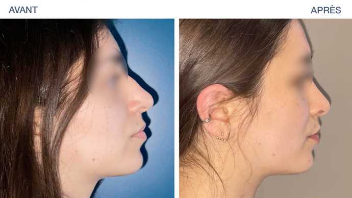 Avant-après : résultat d'une rhinoplastie