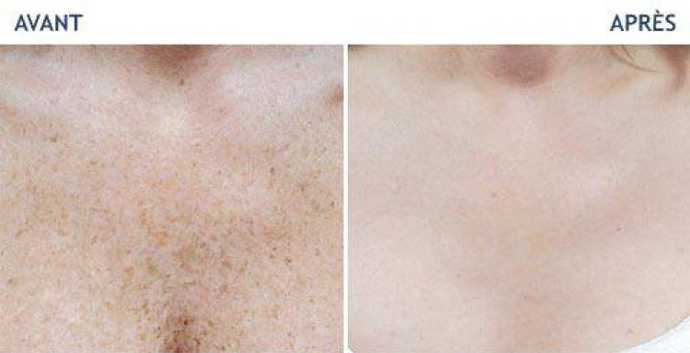 Photos avant - après du résultat d'un traitement des imperfections de la peau par laser Icon