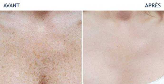 Before and after photos of a laser treatment of 