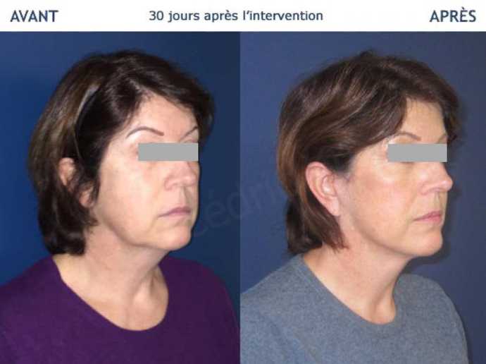 Avant - Après Lifting facial