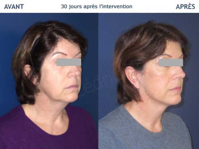 Before - After pictures : plastic surgery procedure of the face