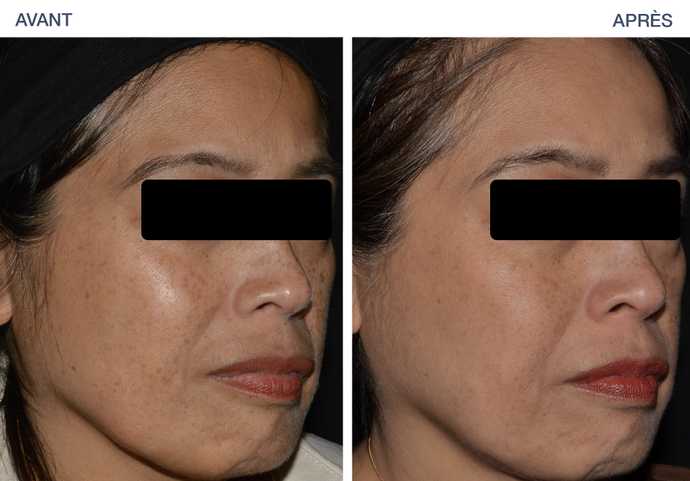 Avant-Après : Traitement des lentigines du visage