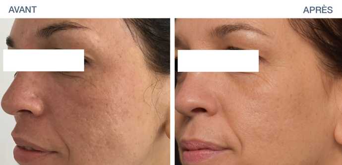 Avant - après : Résultat de Genius sur les cicatrices d'acné