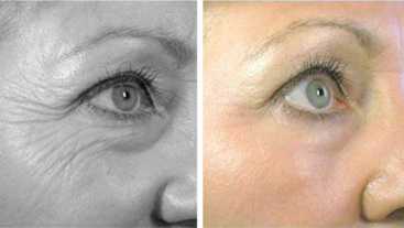 Before & After: Laser treatment - Correction of skin imperfections