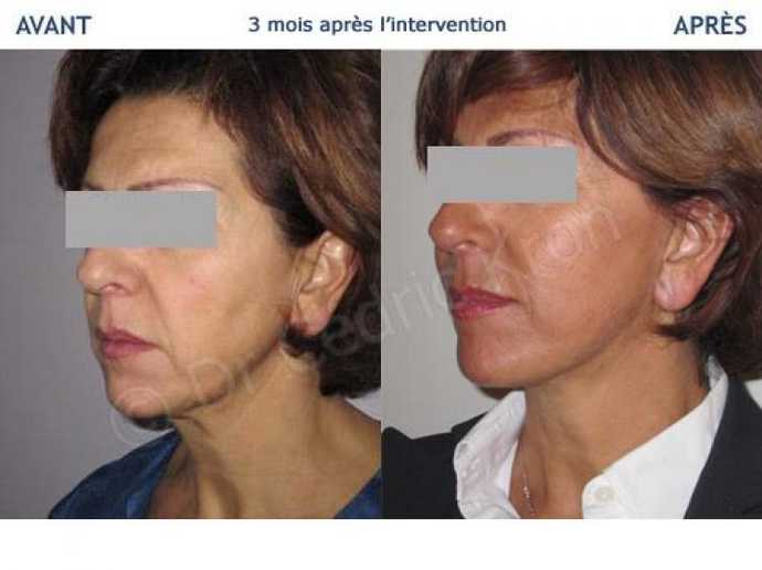 Avant - Après d'un lifting du visage LVPA