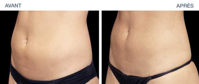 Résultat d'un traitement de sculpting abdominaux par EMSculpt en photo avant-après