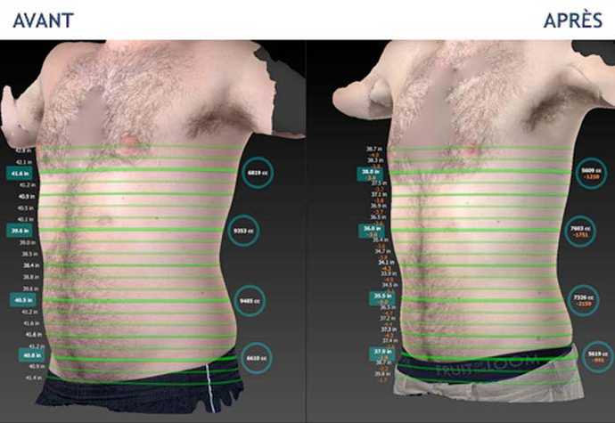 Avant - Après : Traitement du ventre et des poignées d'amour (mesuré avec Vectra XT)