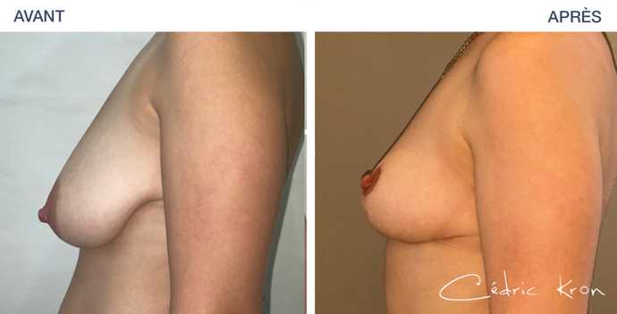 Photo avant-après d'une chirurgie de réduction mammaire vue de profil