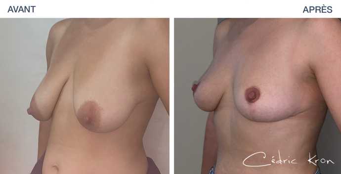Avant-après : réduction des seins sur une femme de 28 ans