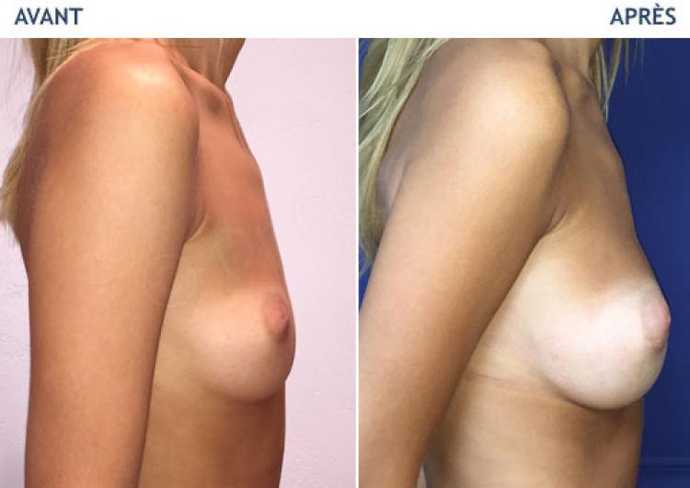 Before - After breast augmentation using implants