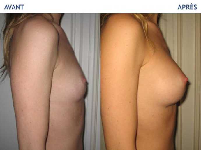 Before - After breast augmentation using implants