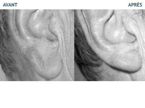 Photo avant-après d'une réduction du lobe d'oreille allongé (plastie double X)