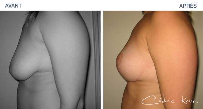 Avant - Après d'une chirurgie de rajeunissement mammaire - lifting des seins