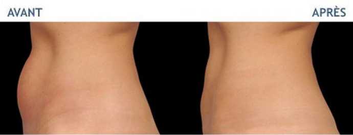 Before & After pictures of Cryolipolyse with Coolsculpting treatment