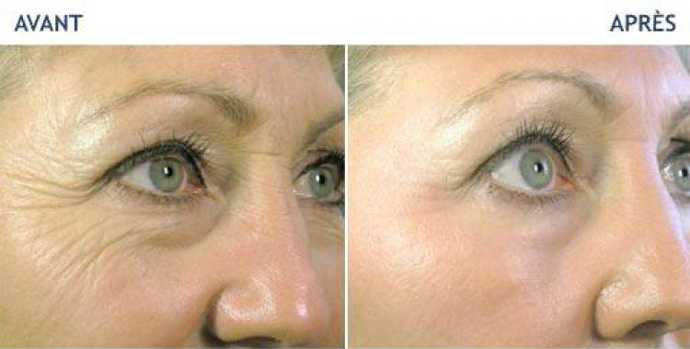Before and after photos of a laser treatment of wrinkles