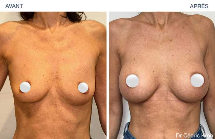 Augmentation mammaire avec implants Ergonomix2 (femme de 52 ans)
