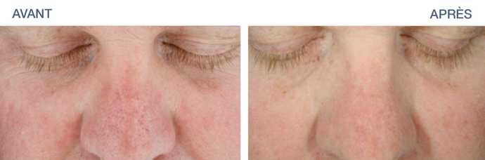 Before - After: Hydrafacial result on sunspots