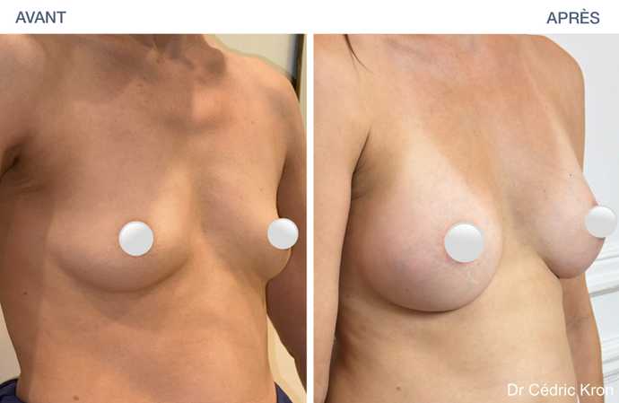 Avant- Après : augmentation mammaire avec implants Ergonomix II (femme de 37 ans)