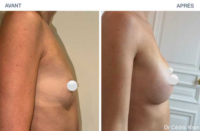 Résultat d'une augmentation mammaire avec Ergonomix 2 chez une femme de 35 ans