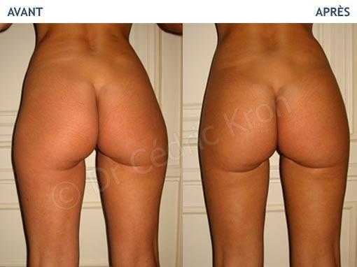 Before-after: aesthetic surgery of the buttocks
