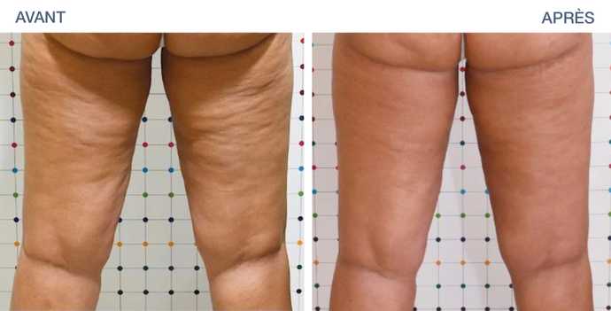 Résultat d'un traitement de la cellulite des cuisses