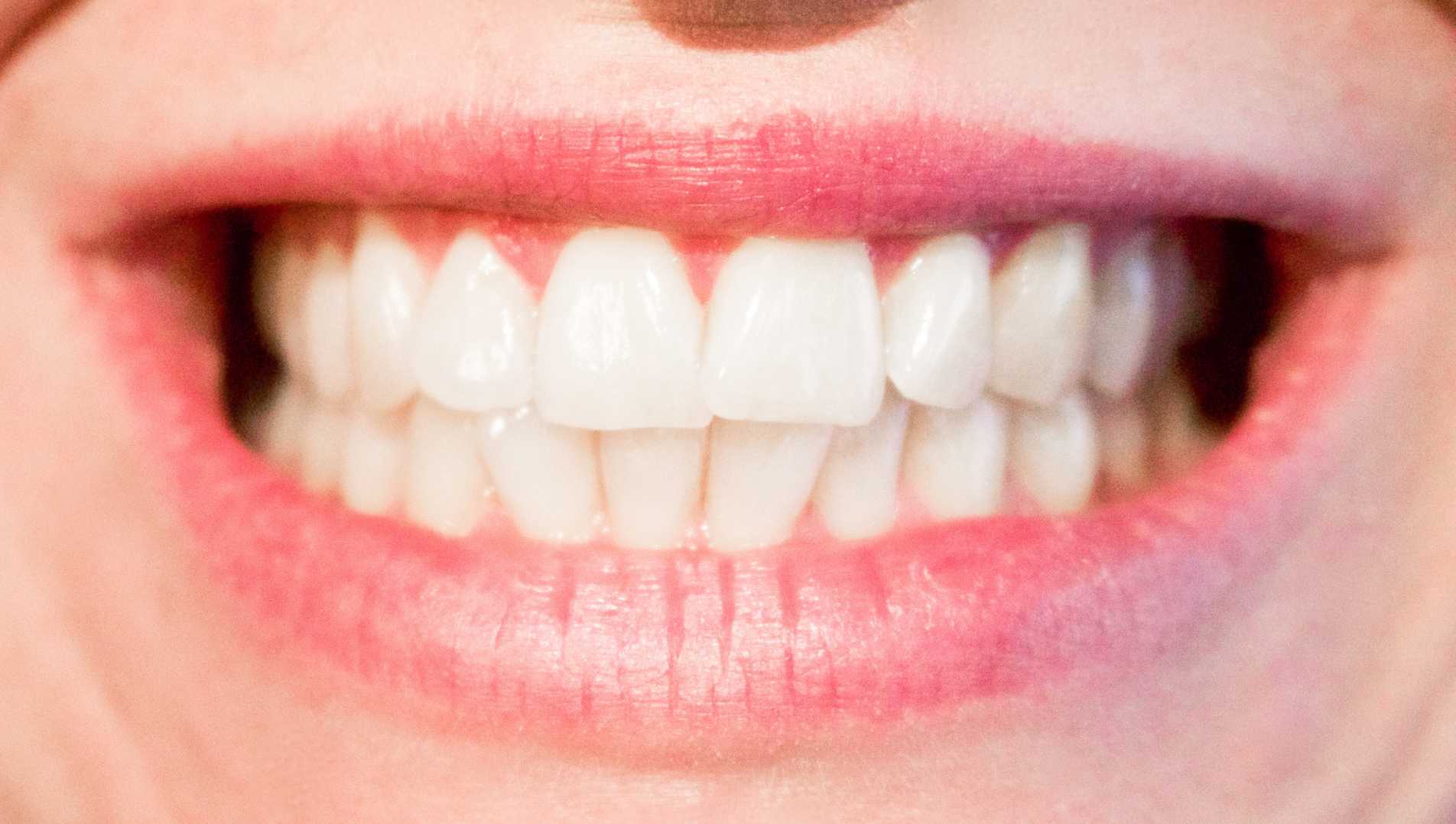 Traitement du bruxisme par injection de toxine botulique (botox)