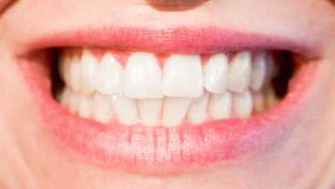 Teeth grinding (bruxism) treatment using Botox